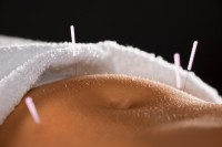 Acupuncture patient | Fertility Acupuncture